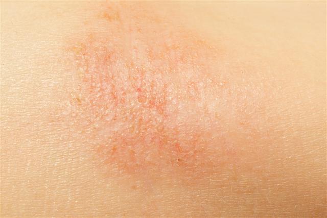 Rashes : MedlinePlus Medical Encyclopedia